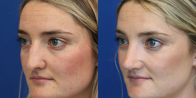 Case 3831 - Woman treated with Rhinoplasty
