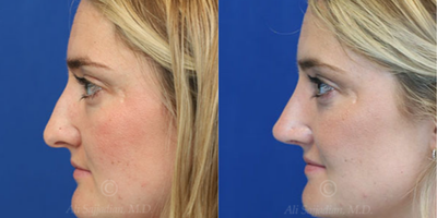 Case 3832 - Woman treated with Rhinoplasty