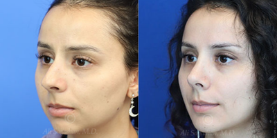 Case 3833 - Woman treated with Rhinoplasty