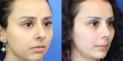Case 3834 - Woman treated with Rhinoplasty