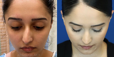 Case 3835 - Woman treated with Rhinoplasty
