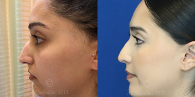 Case 3836 - Woman treated with Rhinoplasty