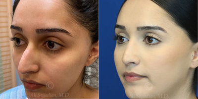 Case 3837 - Woman treated with Rhinoplasty