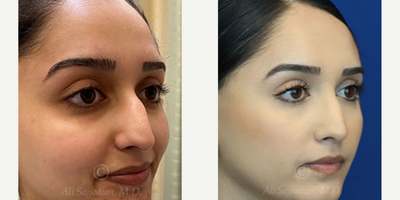 Case 3838 - Woman treated with Rhinoplasty