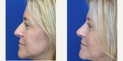 Case 3839 - Woman treated with Rhinoplasty
