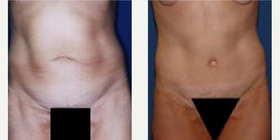 Case 384 - Woman treated with Tummy Tuck