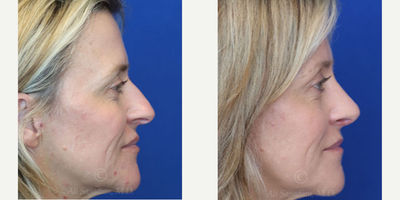 Case 3840 - Woman treated with Rhinoplasty