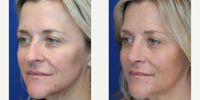 Case 3841 - Woman treated with Rhinoplasty