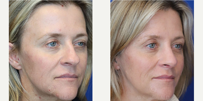 Case 3842 - Woman treated with Rhinoplasty