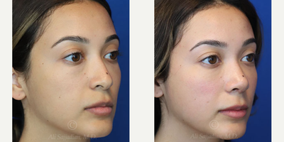 Case 3843 - Woman treated with Rhinoplasty