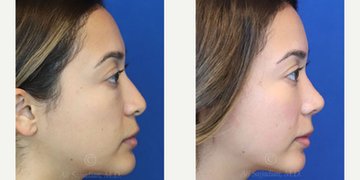 Case 3844 - Woman treated with Rhinoplasty