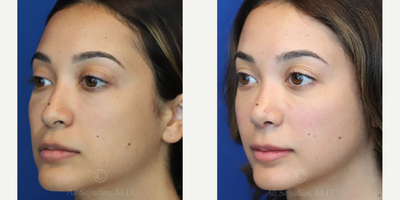 Case 3845 - Woman treated with Rhinoplasty