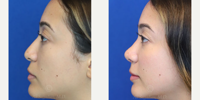 Case 3846 - Woman treated with Rhinoplasty