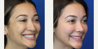 Case 3847 - Woman treated with Rhinoplasty