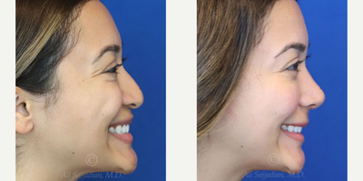 Case 3848 - Woman treated with Rhinoplasty