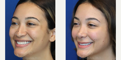 Case 3849 - Woman treated with Rhinoplasty