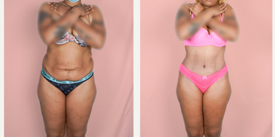 Case 385 - 25-34 year old woman treated with Tummy Tuck