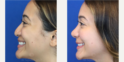 Case 3850 - Woman treated with Rhinoplasty
