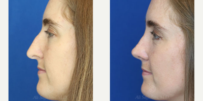 Case 3851 - Woman treated with Rhinoplasty