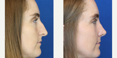 Case 3852 - Woman treated with Rhinoplasty
