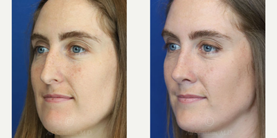 Case 3853 - Woman treated with Rhinoplasty