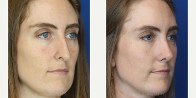 Case 3854 - Woman treated with Rhinoplasty