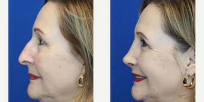 Case 3855 - Woman treated with Rhinoplasty