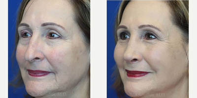 Case 3856 - Woman treated with Rhinoplasty