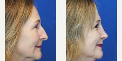 Case 3857 - Woman treated with Rhinoplasty