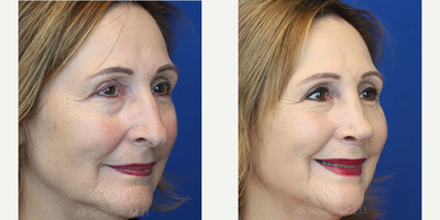 Case 3858 - Woman treated with Rhinoplasty