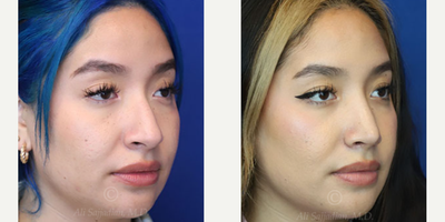 Case 3859 - Woman treated with Rhinoplasty