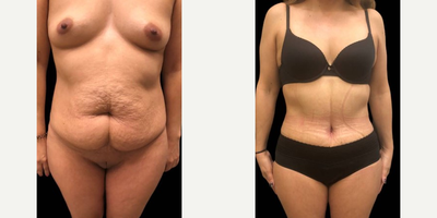 Case 386 - 63 year old woman treated with Tummy Tuck
