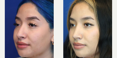 Case 3860 - Woman treated with Rhinoplasty