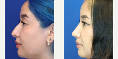 Case 3861 - Woman treated with Rhinoplasty