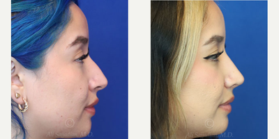 Case 3862 - Woman treated with Rhinoplasty