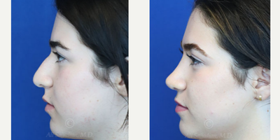 Case 3863 - Woman treated with Rhinoplasty