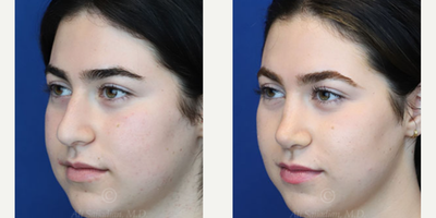 Case 3864 - Woman treated with Rhinoplasty