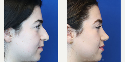 Case 3865 - Woman treated with Rhinoplasty