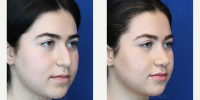 Case 3866 - Woman treated with Rhinoplasty