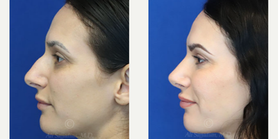 Case 3867 - Woman treated with Rhinoplasty