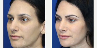 Case 3868 - Woman treated with Rhinoplasty