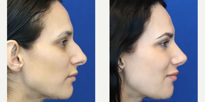 Case 3869 - Woman treated with Rhinoplasty