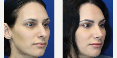 Case 3870 - Woman treated with Rhinoplasty