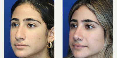Case 3871 - Woman treated with Rhinoplasty