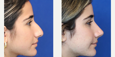 Case 3872 - Woman treated with Rhinoplasty