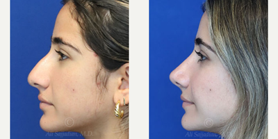 Case 3873 - Woman treated with Rhinoplasty