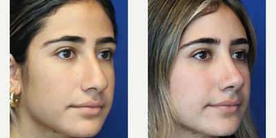 Case 3874 - Woman treated with Rhinoplasty