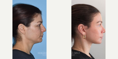 Case 3875 - Woman treated with Rhinoplasty