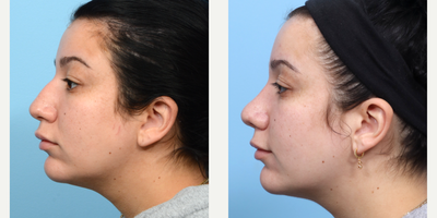 Case 3878 - 18-24 year old woman treated with Rhinoplasty