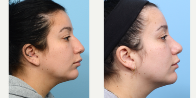 Case 3879 - 18-24 year old woman treated with Rhinoplasty
